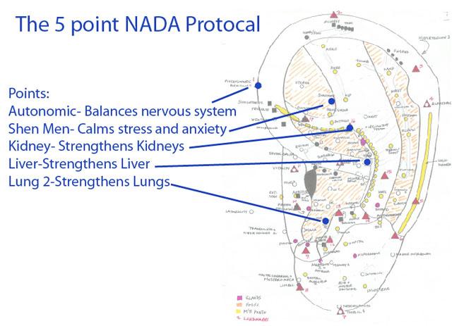 NADA-5-point-acupuncture